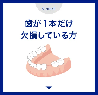 歯が一本だけ欠損している方